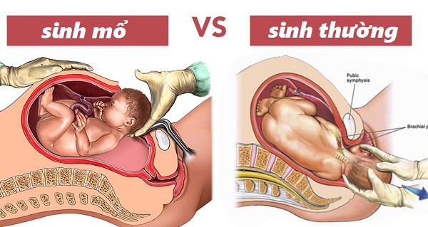 Băn khoăn lựa chọn sinh thường hay sinh mổ