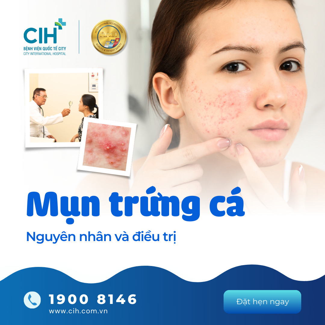 Mụn trứng cá nguyên nhân và cách điều trị 