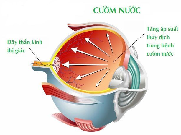 Dấu hiệu và tầm soát bệnh cườm nước